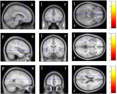 Correlation Between the Wechsler Adult Intelligence Scale- 3rd Edition Metrics and Brain Structure in Healthy Individuals: A Whole-Brain Magnetic Resonance Imaging Study
